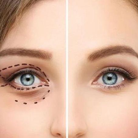 Eyelid   Saudia